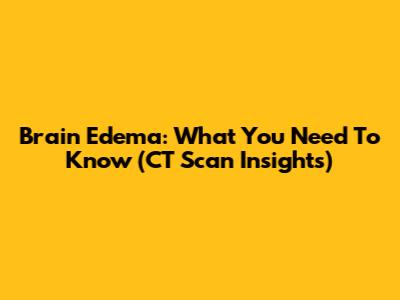 Brain Edema: What You Need To Know (CT Scan Insights)