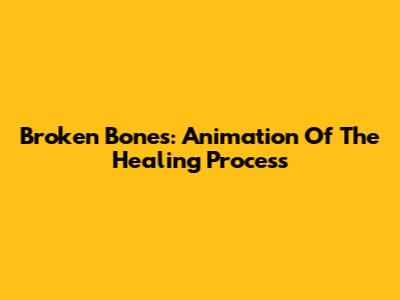 Broken Bones: Animation Of The Healing Process